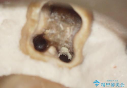 咬んだ時の違和感 顕微鏡で発見された歯の穴を処置し、かみ合わせを回復するの治療中