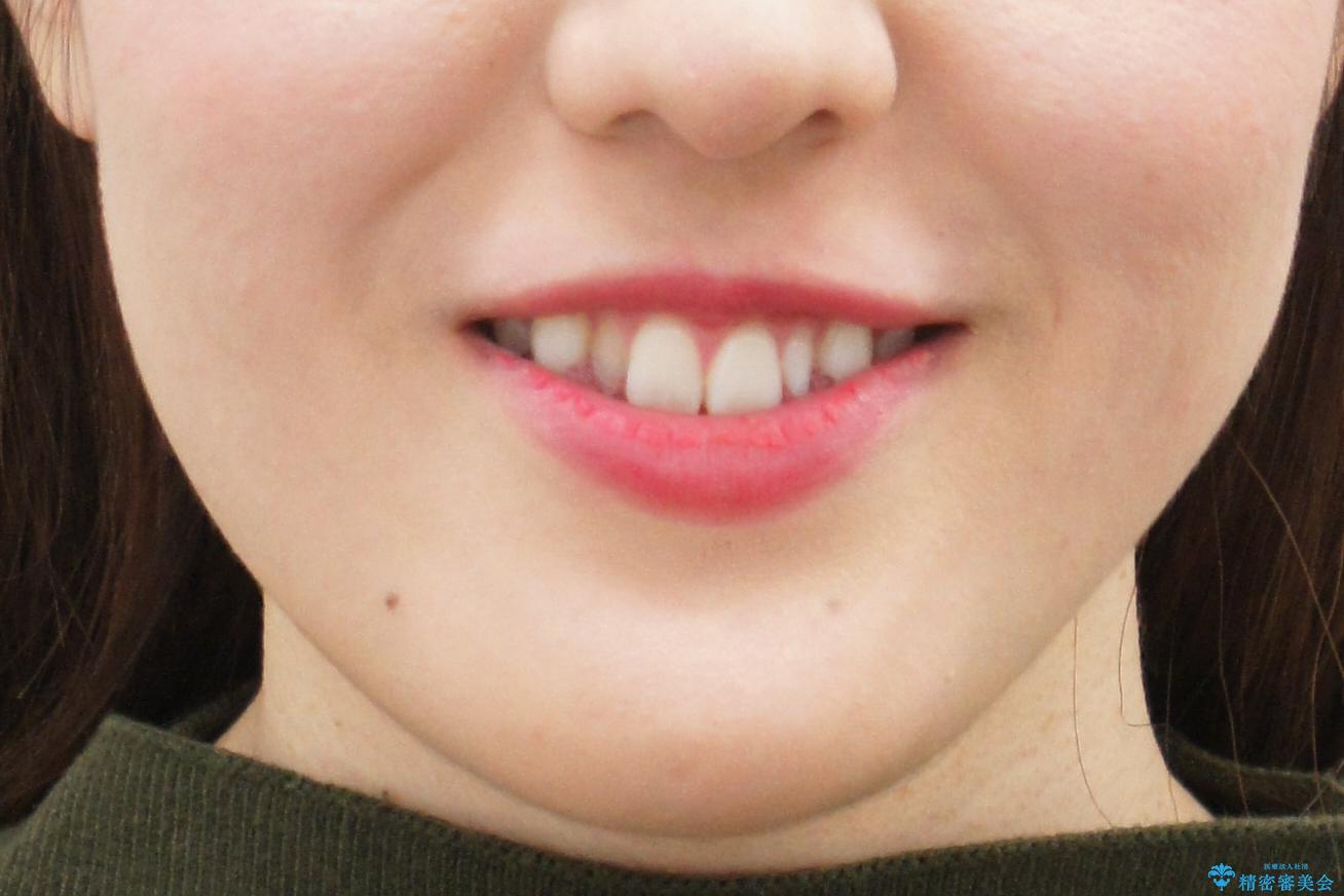 矮小歯 インビザラインとセラミックで美しくの治療前(顔貌)