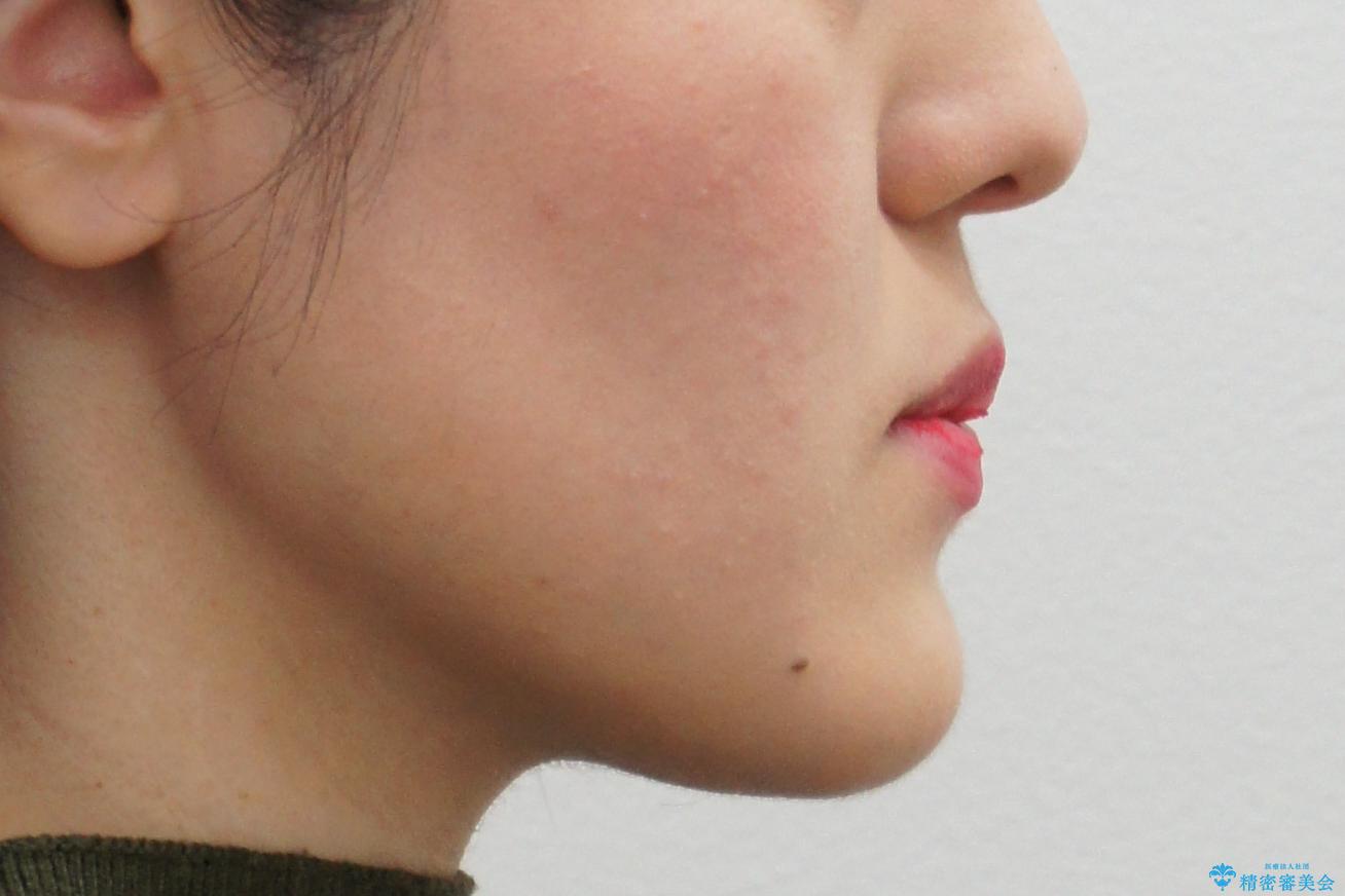 矮小歯 インビザラインとセラミックで美しくの治療前(顔貌)
