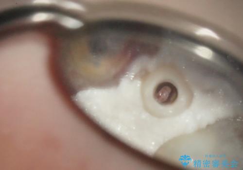 前歯がぐらぐらする 抜歯→ブリッジへ の治療中