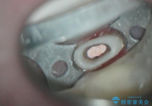 歯周外科・根管治療による長期予後を期待する奥歯の治療の治療中