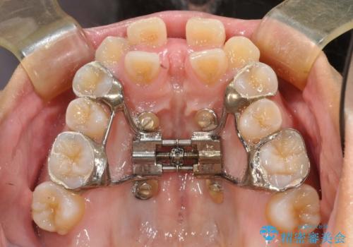 人生が変わる 困難を極める咬合状態に歯列矯正単独で挑戦するの治療中