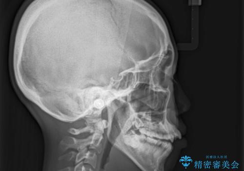 人生が変わる 困難を極める咬合状態に歯列矯正単独で挑戦するの治療前