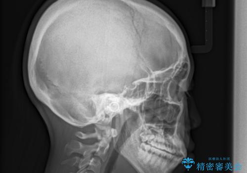 人生が変わる 困難を極める咬合状態に歯列矯正単独で挑戦するの治療後