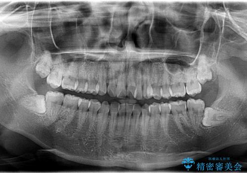インビザラインによるガタつきの矯正治療 シンプル・短期間の治療前
