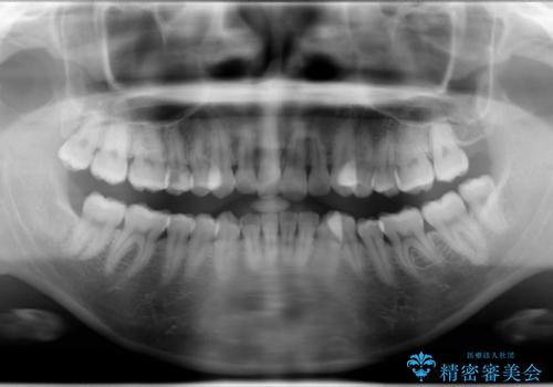 抜歯をして前歯を下げ、ガタつきを取り除く ワイヤー矯正の治療前