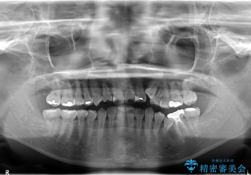 ハーフリンガル抜歯矯正　八重歯を改善するの治療前