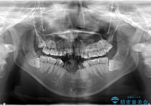 人生が変わる 困難を極める咬合状態に歯列矯正単独で挑戦するの治療前