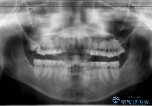 人生が変わる　困難を極める咬合状態に歯列矯正単独で挑戦するの治療後