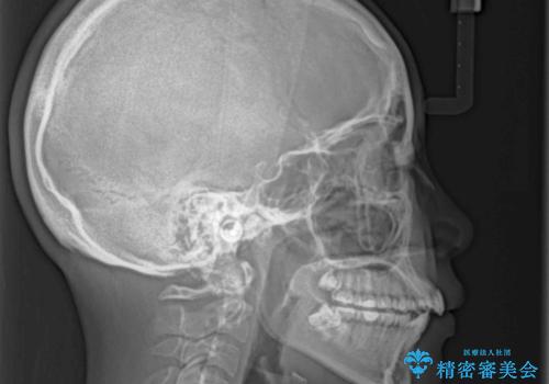 デコボコで飛び出した前歯をきれいに インビザラインによる矯正治療の治療前