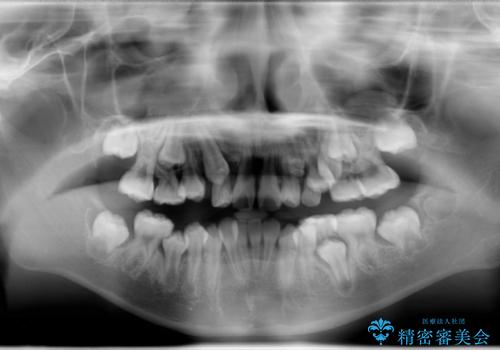 永久歯が生えてこない ワイヤー矯正で複雑な状態を正常咬合へ誘導するの治療前
