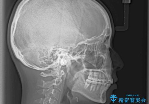 口が閉じにくい 1本飛び出した前歯の矯正治療の治療後