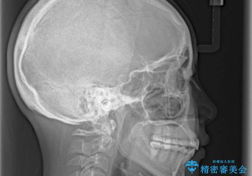 デコボコで飛び出した前歯をきれいに インビザラインによる矯正治療の治療後