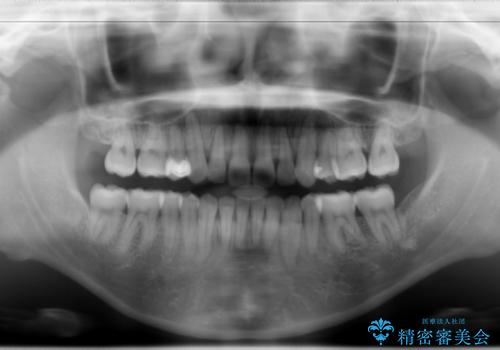 抜歯をして前歯を下げ、ガタつきを取り除く ワイヤー矯正の治療後