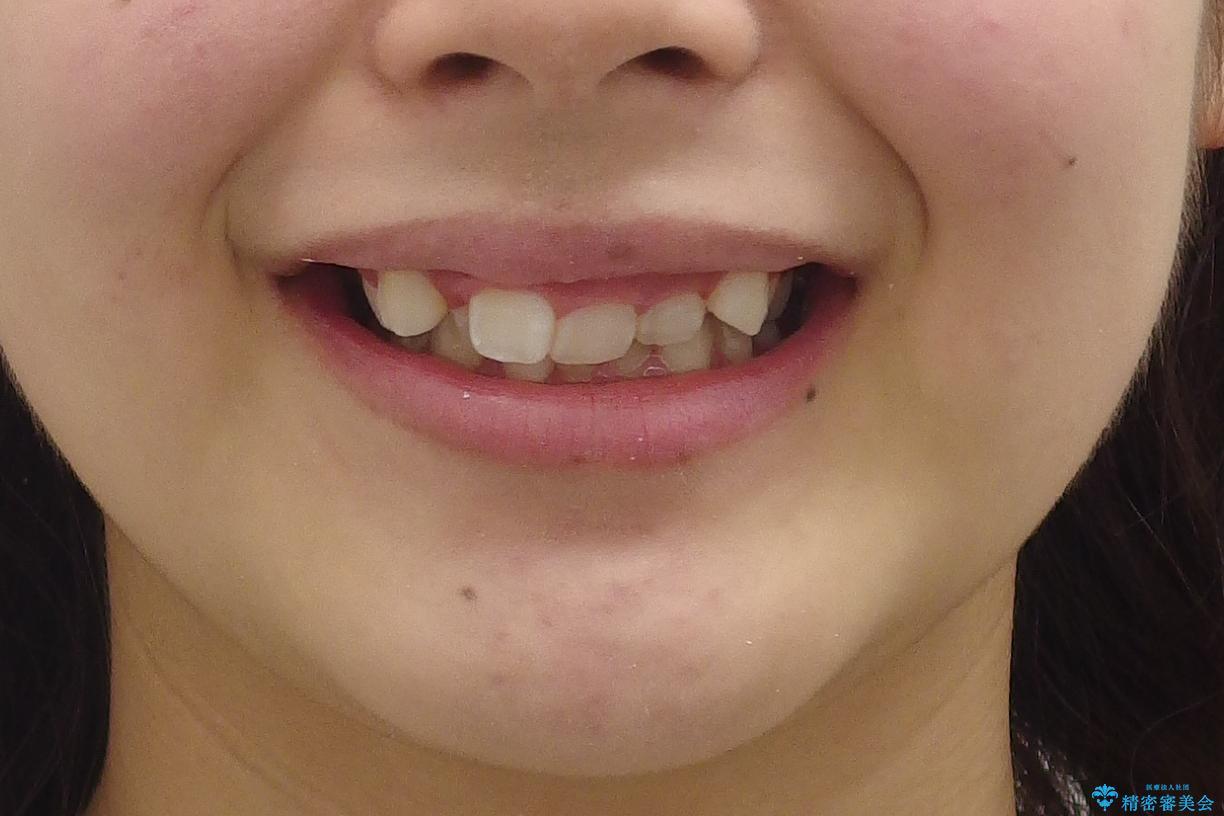 前歯のがたがた　前歯が内側に傾いているの治療前（顔貌）