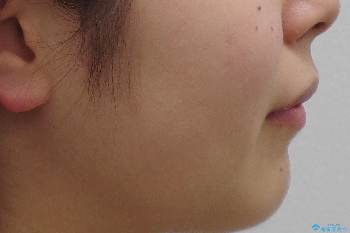 前歯のがたがた 前歯が内側に傾いているの治療前(顔貌)