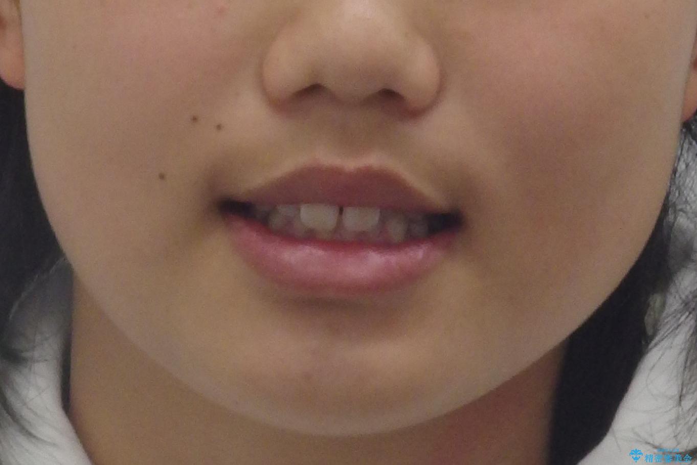 前歯のすきま 矯正治療とセラミックで小さな歯を形良くの治療前(顔貌)