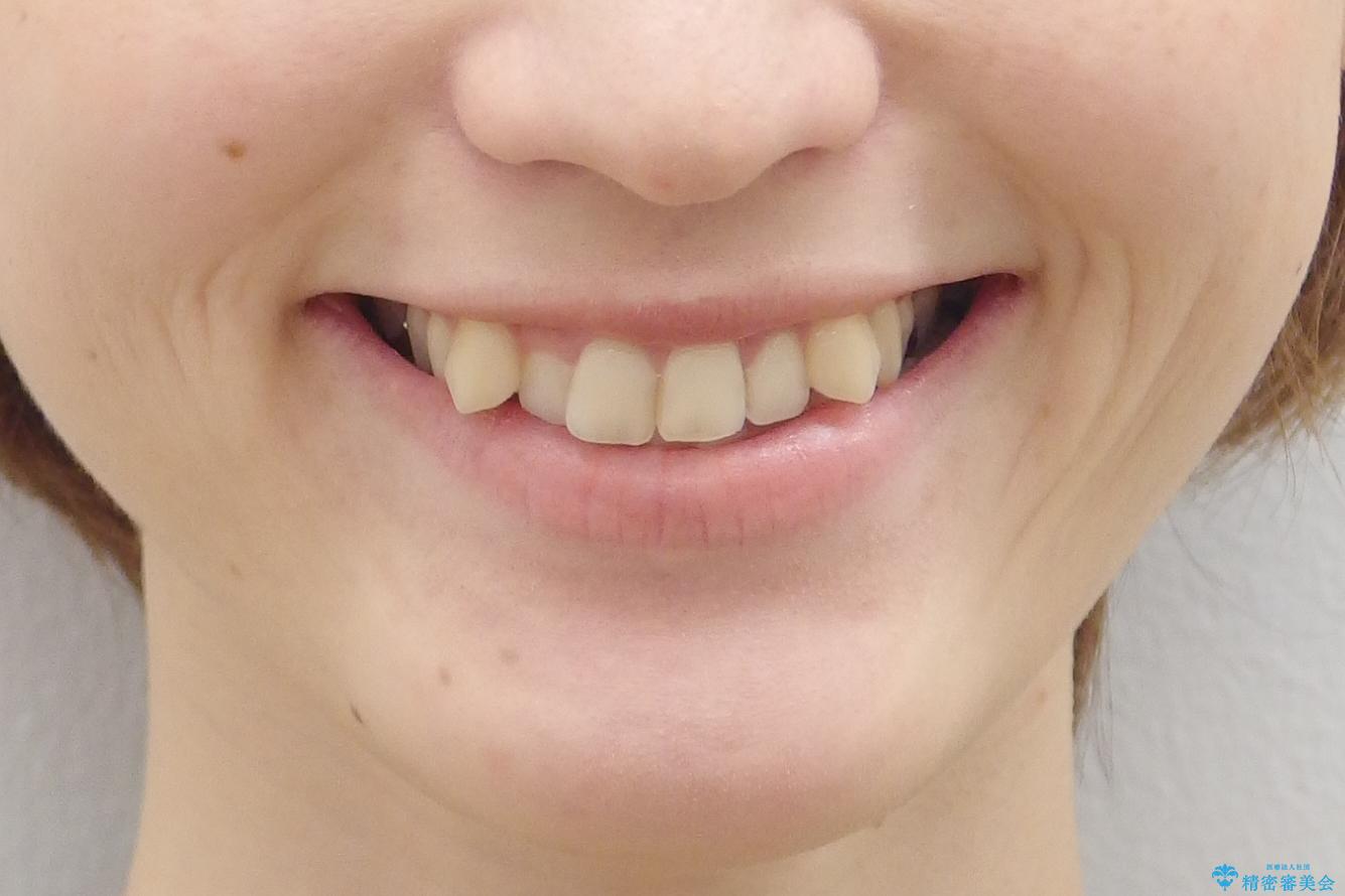 抜かない、削らない矯正 大人も上顎を骨から広げますの治療前(顔貌)