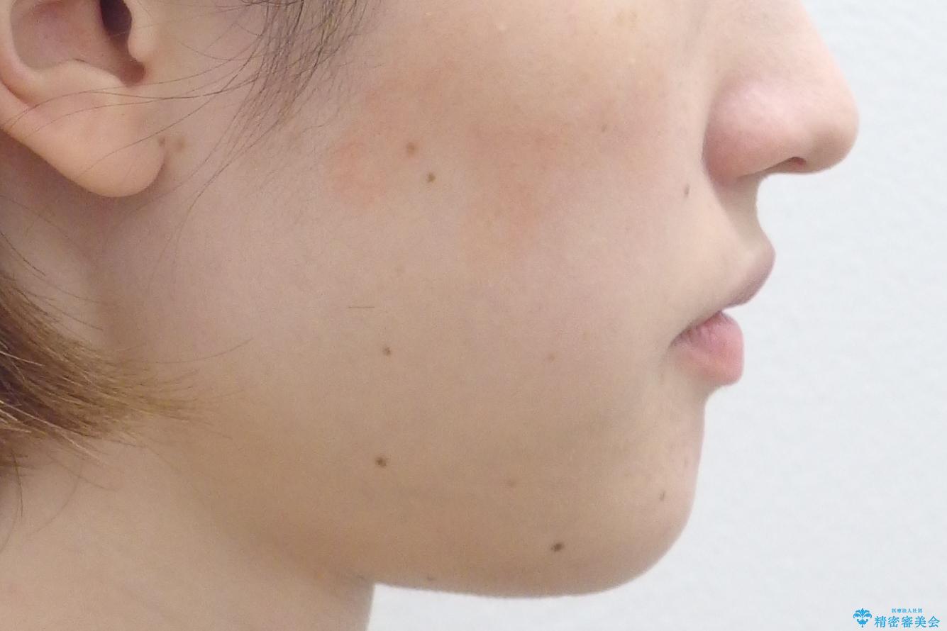 抜かない、削らない矯正 大人も上顎を骨から広げますの治療前(顔貌)