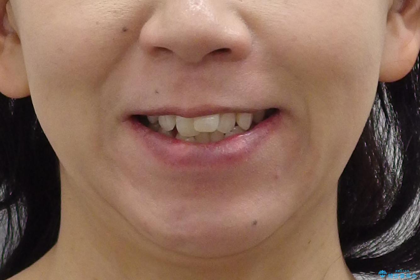 40代女性　前歯の重なり　あきらめずに矯正の治療前（顔貌）