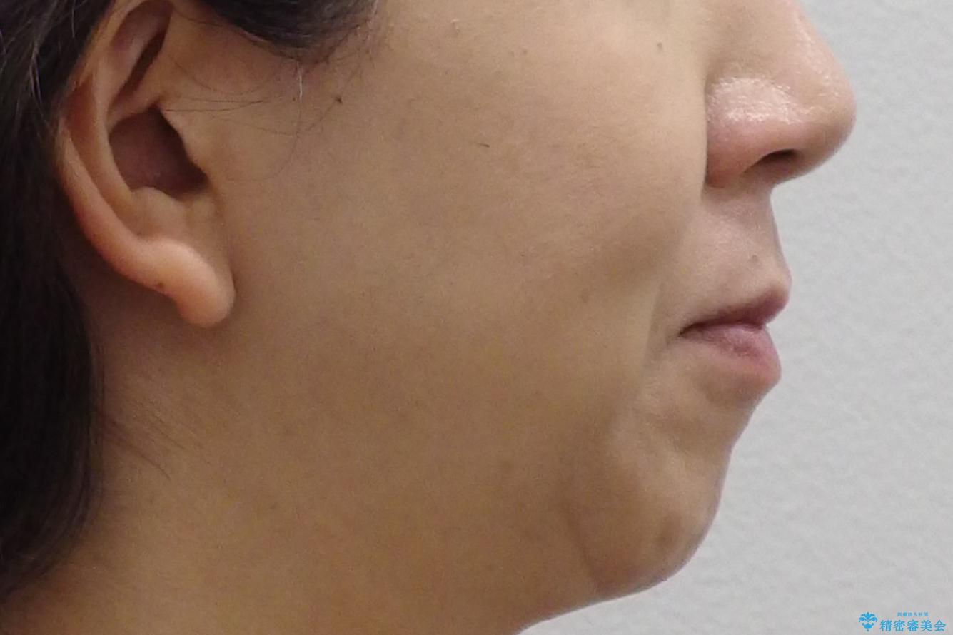 40代女性　前歯の重なり　あきらめずに矯正の治療前（顔貌）