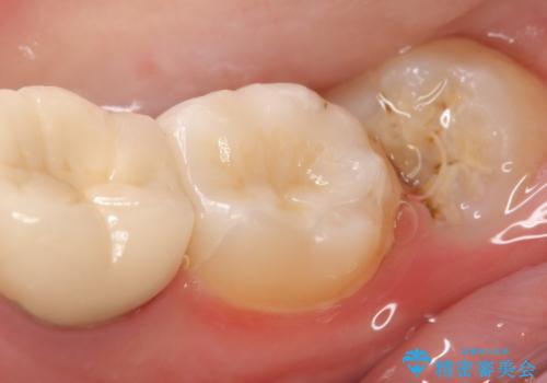 セラミックインレー 古い銀歯の治療の治療後