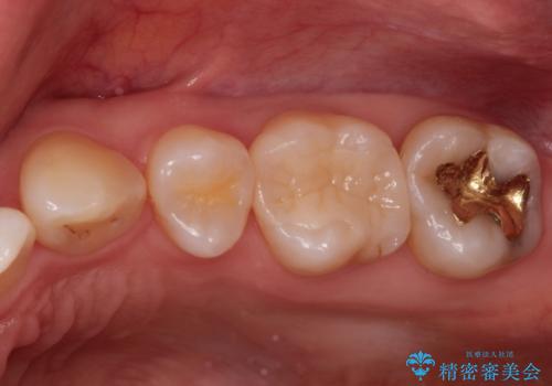 一度治療した歯が虫歯に　セラミックインレーで治療の治療後