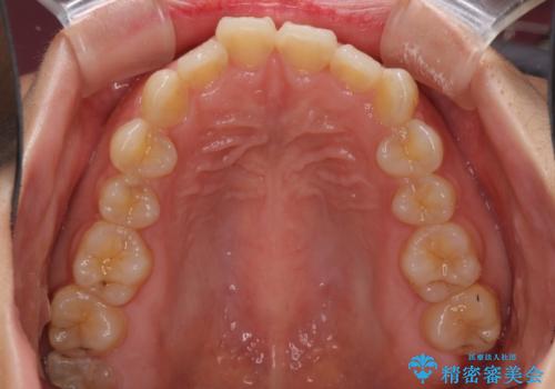 前歯のデコボコを治したい インビザラインによる矯正治療の治療前