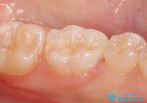 セラミックインレー しみる歯の治療の治療後