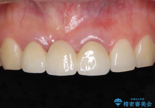 歯肉から血が　前歯のオールセラミックブリッジの再製作の症例 治療前