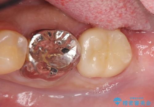 歯冠長延長術を併用した審美的歯科治療の症例 治療後