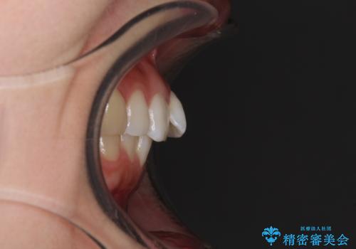 口が閉じにくい 1本飛び出した前歯の矯正治療の治療前