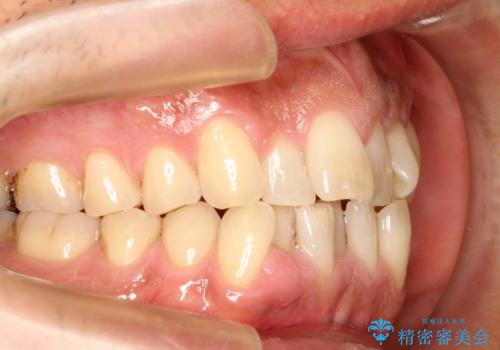 インビザライン invisalign ガタつきを治すマウスピース矯正の治療前