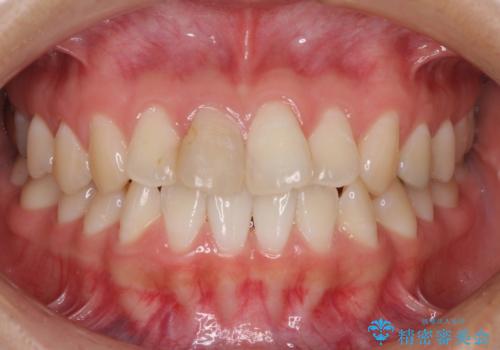 変色した歯をセラミックにしたい　歯自体が変色している場合の参考用2の治療前