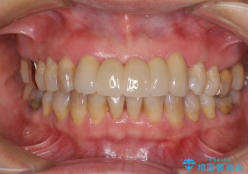 古くなった前歯のブリッジをオールセラミックにの治療後