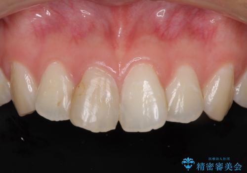 変色した歯をセラミックにしたい 歯自体が変色している場合の参考用2の治療前