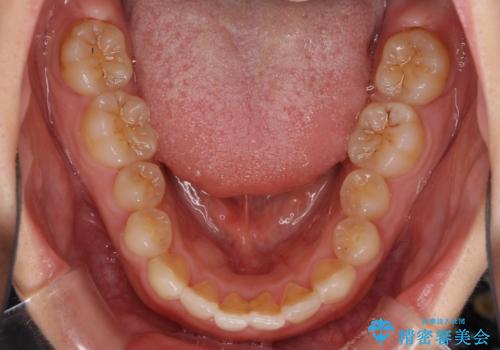 前歯のデコボコを治したい インビザラインによる矯正治療の治療前