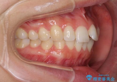 口が閉じにくい 1本飛び出した前歯の矯正治療の治療前