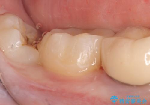 セラミックインレー 古い銀歯の治療の治療後