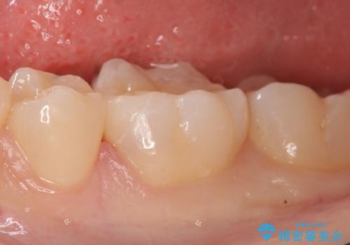 セラミックインレー しみる歯の治療の治療後