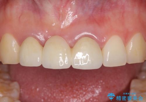 歯肉から血が 前歯のオールセラミックブリッジの再製作の治療前