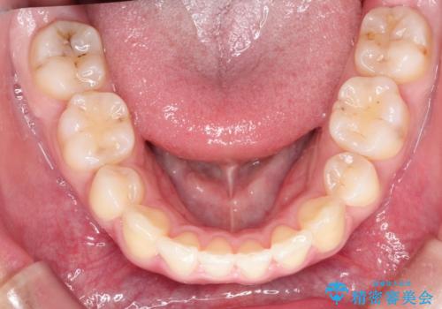 前歯が八重歯でガタガタ　ワイヤーによる抜歯矯正の治療後