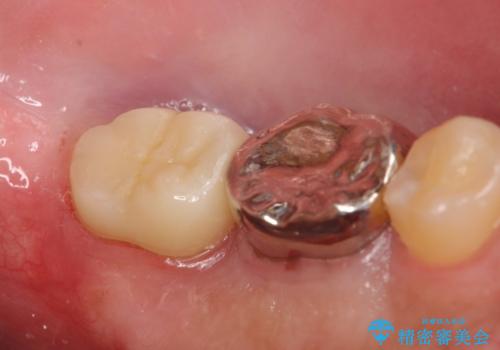 歯冠長延長術を併用した審美的歯科治療の治療後