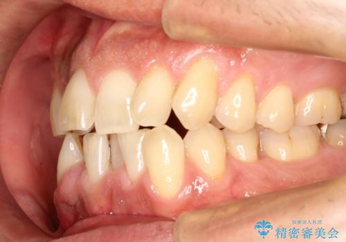 インビザライン invisalign ガタつきを治すマウスピース矯正の治療前