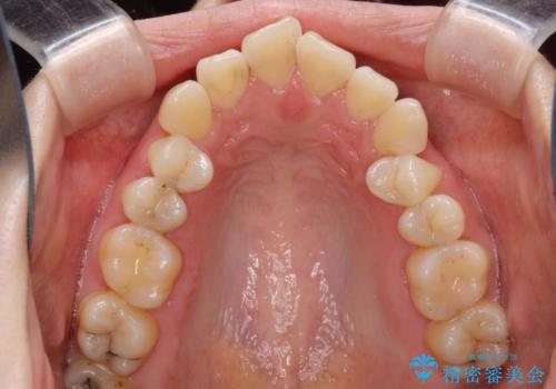 抜歯をして前歯を下げ、ガタつきを取り除く ワイヤー矯正の治療前