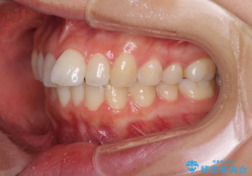 口が閉じにくい　1本飛び出した前歯の矯正治療の治療前