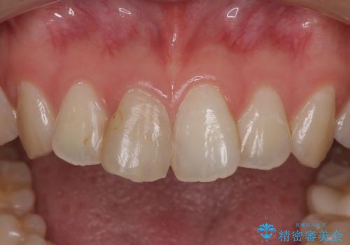 変色した歯をセラミックにしたい 歯自体が変色している場合の参考用2の治療前
