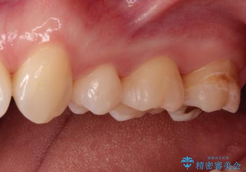 一度治療した歯が虫歯に セラミックインレーで治療の治療後