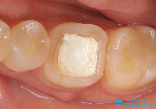 オールセラミッククラウン 根管治療後の補綴の治療前