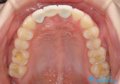 歯肉から血が 前歯のオールセラミックブリッジの再製作の治療前